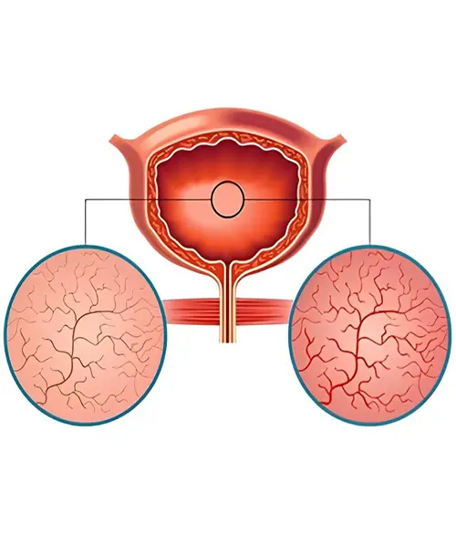 Interstitial Cystitis