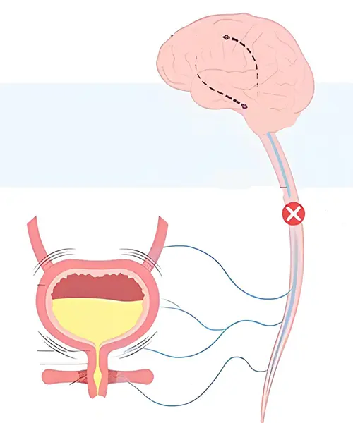 Neurogenic Bladder